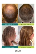 پروتئین مو pHLab Hair Exosome، NAD+ و تزریق سه‌گانه PDRN برای پوست سر