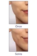 دستگاه اپیلاسیون موهای صورت، ابرو و سبیل