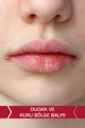 بالم مرطوب کننده و نرم کننده لب و نواحی خشک برای پوست‌های خشک و حساس 30 میلی‌لیتر