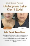 کرم روشن کننده پوست، کرم لکه، تیرگی، آکنه، لکه‌های آفتاب، کرم لکه روشن کننده با گلوتاتیون 50 میلی لیتر